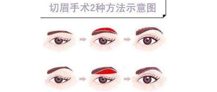切眉術.jpg