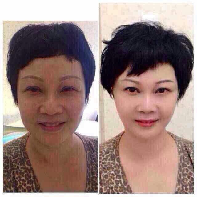 彩光嫩膚后.jpg
