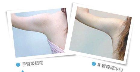 手臂吸脂3-林賢超