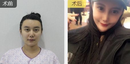 駝峰鼻矯正對(duì)比.jpg