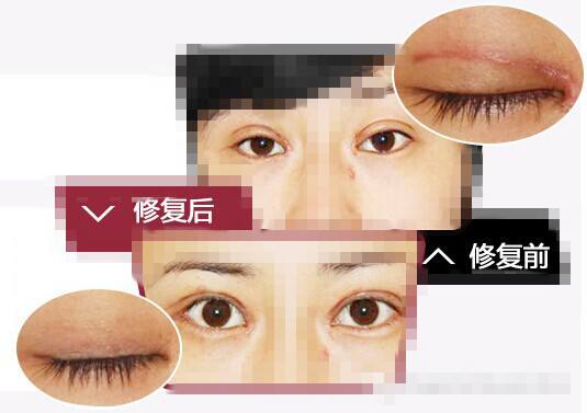 雙眼皮修復.jpg